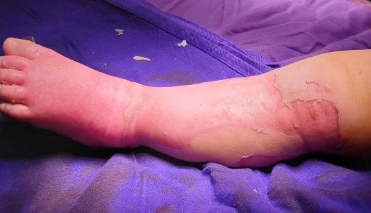 Cha mẹ tự ý đắp lá khi bị bỏng, cháu bé 9 tháng tuổi tử vong 