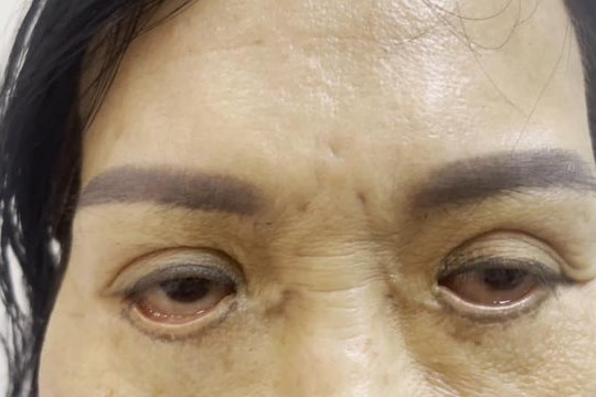 Mắt đỏ hoe, không nhắm được sau khi cắt mí "chui"