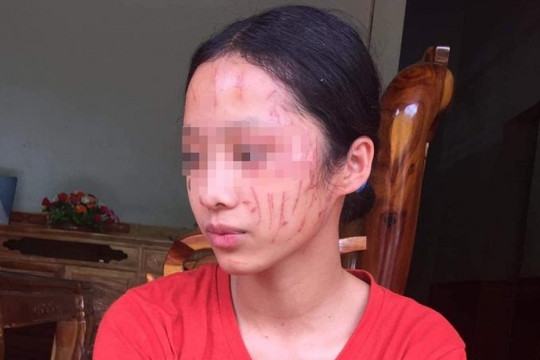 Bảo vệ em, nữ sinh lớp 8 bị bạn cào cấu khắp mặt