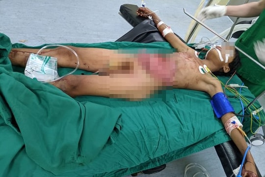 Cứu sống bệnh nhân 14 tuổi gặp tai nạn giao thông khiến ruột ở ngoài ổ bụng