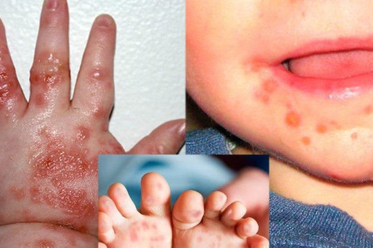 Bộ Y tế ra công văn khẩn về phòng, chống dịch tay chân miệng