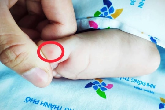 Nhập viện sau 4 ngày nôn ói, bé 6 tuổi phát hiện bị tay chân miệng mức nặng