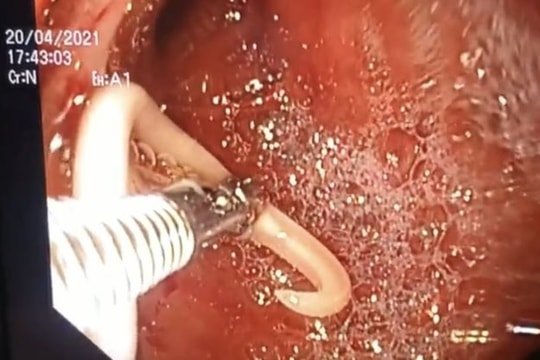 Giun đũa dài 15cm chui vào ống tụy bé trai 5 tuổi