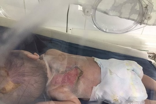 Người lớn lấy kim chích mụn, bé sơ sinh bị nhiễm trùng huyết nguy kịch