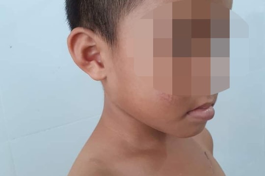 Cha dượng bạo hành tàn độc bé trai 6 tuổi