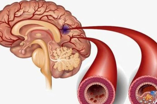Nếu xảy ra 4 tình huống này sau bữa ăn, dự báo có thể cơn nhồi máu não sắp đến