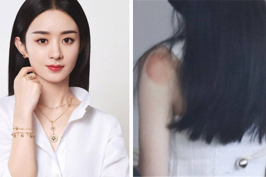 Triệu Lệ Dĩnh để lộ vết đỏ lớn sau vai giữa tin đồn ngừng đóng nghim, tập trung giành quyền nuôi con với Phùng Thiệu Phong