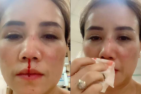 Diễn viên Hoàng Yến lộ khuôn mặt sưng to, bầm tím và máu mũi chảy khiến dân mạng lo lắng