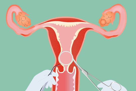 Phụ nữ có 3 cái 'bất thường' là cổ tử cung có thể 'thối như lưới bắt cá', nếu không có, xin chúc mừng bạn
