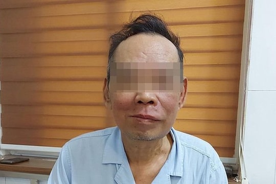 Trì hoãn điều trị khối u vì Covid-19, người đàn ông bị biến dạng mặt