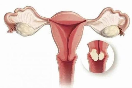 Chảy máu sau khi 'quan hệ', đây có phải là dấu hiệu của bệnh ung thư cổ tử cung?