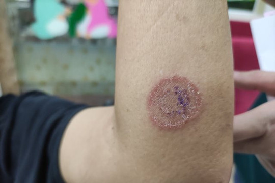 Ngủ chung với thú cưng, nhiều người vào viện vì bệnh nấm da