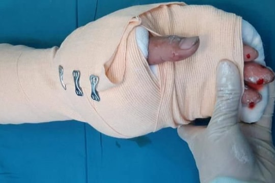 Cà Mau: Nối thành công bàn tay bị chém đứt lìa