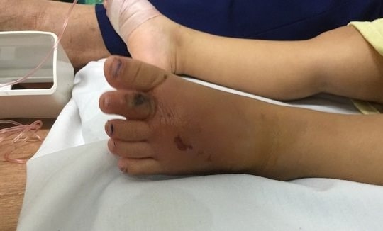 Đắp thuốc nam khi bị rắn cắn, bé 13 tuổi tử vong