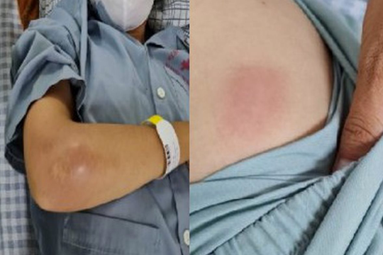 Khó thở, sốt cao, cô gái trẻ bất ngờ phát hiện bị nhiễm vi khuẩn “ăn thịt người” Whitmore