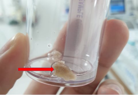 Bé 20 tháng suy hô hấp bởi mảnh xương trong nước hầm cháo cắm vào phế quản