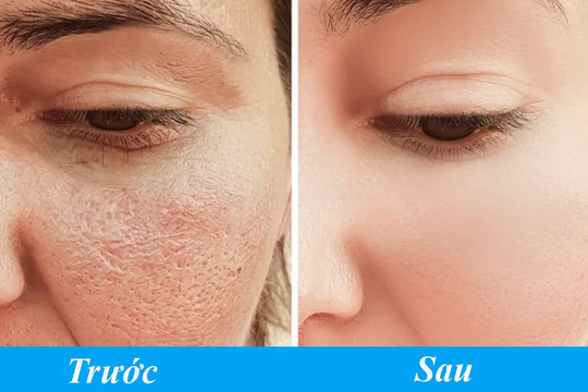 7 mẹo của chuyên gia giúp bạn thu nhỏ lỗ chân lông, chấm dứt tình trạng da bóng nhờn