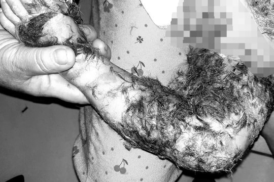 Bé 8 tháng tuổi bị nhiễm trùng vì đắp lông động vật chữa bỏng