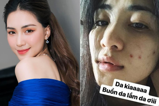 Gương mặt từng nổi chi chít mụn, Hòa Minzy chăm dưỡng theo những bước này để làn da láng bóng, căng mịn