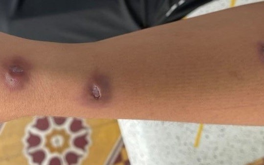 Phát hiện bệnh lao da sau khi bị gai tôm đâm