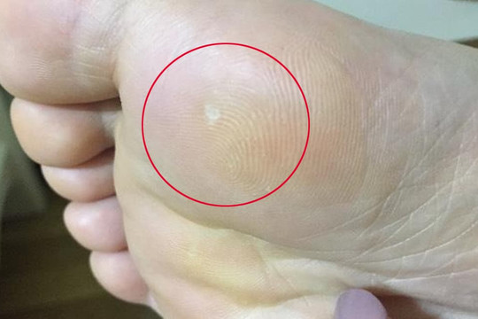 Có bệnh trong cơ thể, tiên tri chân! Nếu bàn chân phát ra 3 dấu hiệu 'bất thường' này, cần chú ý kiểm tra kịp thời