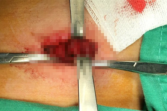 Bé 8 tuổi đứt khí quản do lưỡi cưa đá văng trúng