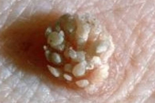 Một phụ nữ 28 tuổi bị phát hiện dương tính với HPV khiến chồng xa lánh!  Bác sĩ: Thực hiện 3 điều có thể chuyển thành âm tính