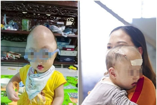 Hộp sọ đóng kín khiến bé 16 tháng tuổi ngủ không nhắm mắt
