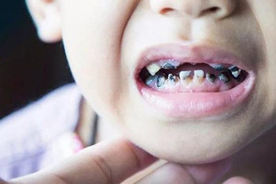 Đứa trẻ 7 tuổi 'răng thối đen', sau khi khám bệnh bác sĩ phê bình: 'Đúng là phụ huynh vô trách nhiệm'