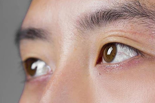 Lòng trắng của mắt có màu vàng, có phải bạn bị viêm gan không? Bác sĩ: Có 3 loại khó chịu ở mắt, hãy kiểm tra gan càng sớm càng tốt