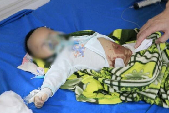Đắp tỏi điều trị Covid-19, bé 2 tháng tuổi co giật nguy kịch