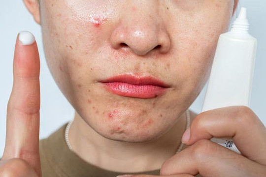 5 cách để điều trị mụn, khắc phục tình trạng mụn nhỏ tạo thành sẹo