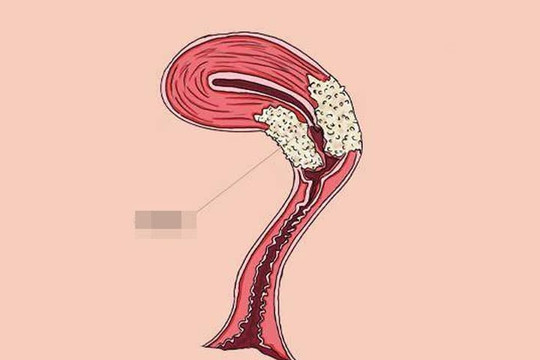 Phụ nữ khi đi vệ sinh hãy để ý nếu có 3 dấu hiệu này thì có lẽ tử cung đang 'cầu cứu'