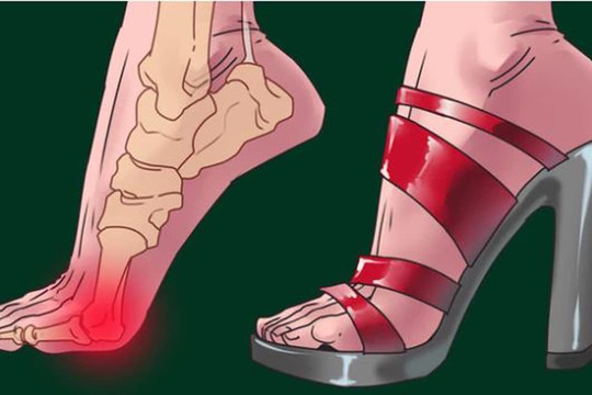 Giày cao gót không chỉ làm hỏng bàn chân của bạn: Có 3 bộ phận cơ thể khác cũng gặp 'nguy hiểm'