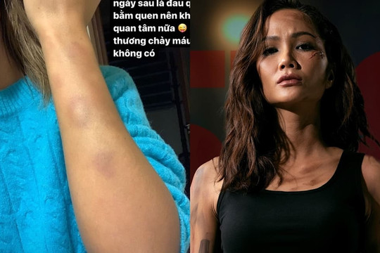 H'Hen Niê 'khoe' vết bầm tím chi chít trên cơ thể khi quay dự án phim mới