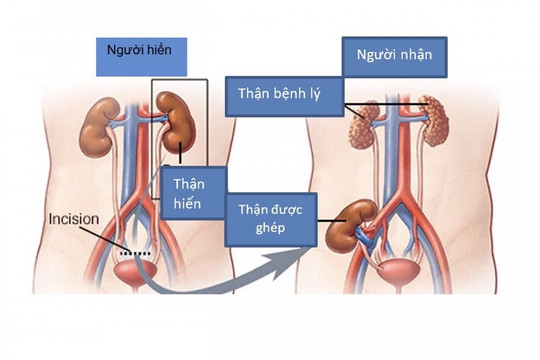 300 cháu bé được sinh ra từ nhiều ca ghép thận thành công