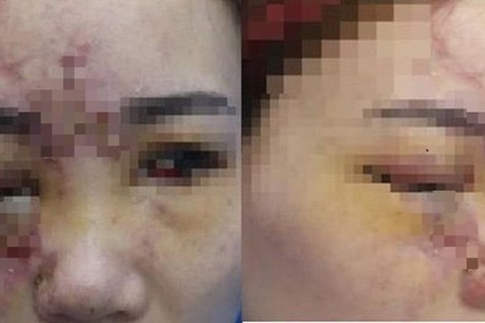 Mất thị lực sau khi tiêm filler làm đầy rãnh má tại tiệm tóc