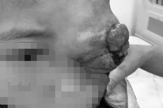 Khối u lớn ở mắt khiến cậu bé dân tộc Thái bị biến dạng cả mặt