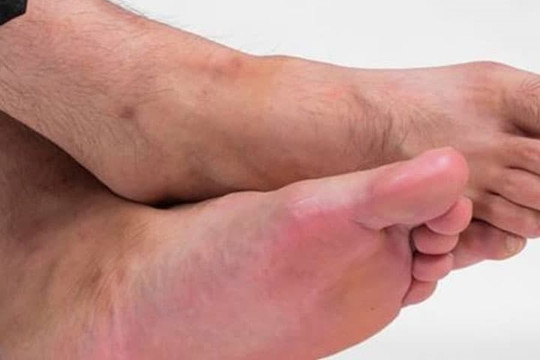 Đã tìm ra “thủ phạm” gây nên mùi hôi chân. Để khử mùi hôi chân vào mùa hè, bạn cũng có thể thêm thứ này vào nước rửa chân