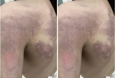 Tạm đình chỉ cô giáo trong vụ bé gái lớp 3 bị đánh bầm tím người