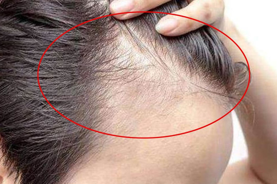 Làm gì nếu tóc mỏng và không dày? Làm tốt 5 điều này, tóc bạn sẽ mọc dày lên