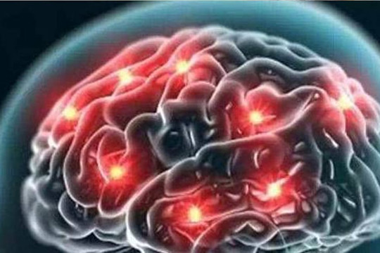Không đủ máu cung cấp cho não, có thể có 3 'thay đổi tế nhị' này mà hầu hết mọi người đều bỏ qua