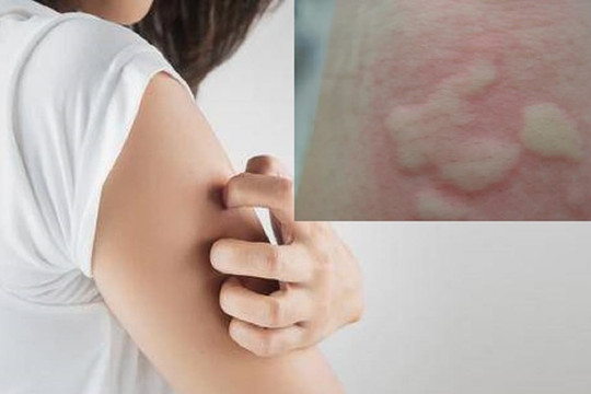Làm thế nào để hết ngứa mề đay trong mùa hè? Phòng ngừa và điều trị nên được thực hiện trong ba bước, bạn đã hiểu chưa?