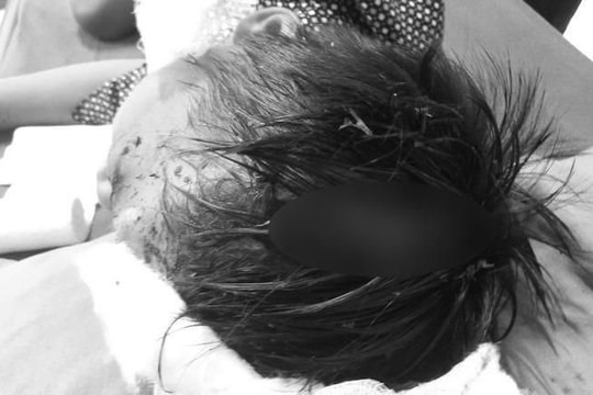 Bé 8 tuổi bị chó cắn đa thương tích, lộ xương sọ