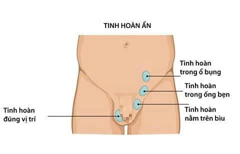 Bé trai phải cắt bỏ tinh hoàn vì thăm khám trễ