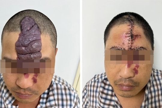 Tái tạo khuôn mặt cho người đàn ông bị dị tật bẩm sinh
