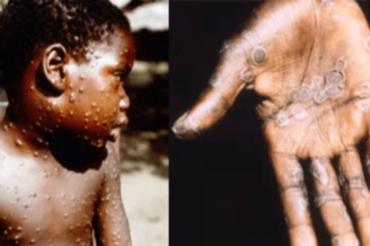 EU mua 110.000 liều vaccine ngừa bệnh đậu mùa khỉ