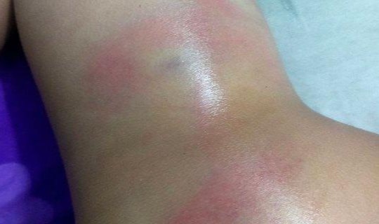 Bình Dương: Giao công an xác minh vụ bé gái bị cô giáo đánh