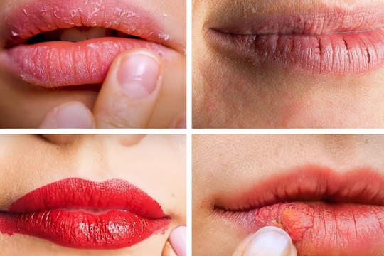 Mùa hè môi thường bị khô, xỉn màu, gợi ý bạn cách chăm sóc để đôi môi luôn mịn màng