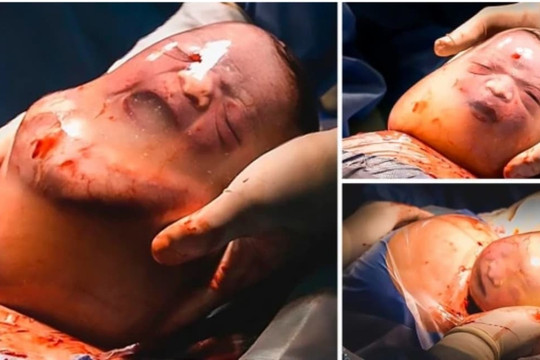 Khoảnh khắc hiếm gặp: Một bé trai chào đời còn nguyên trong bọc ối